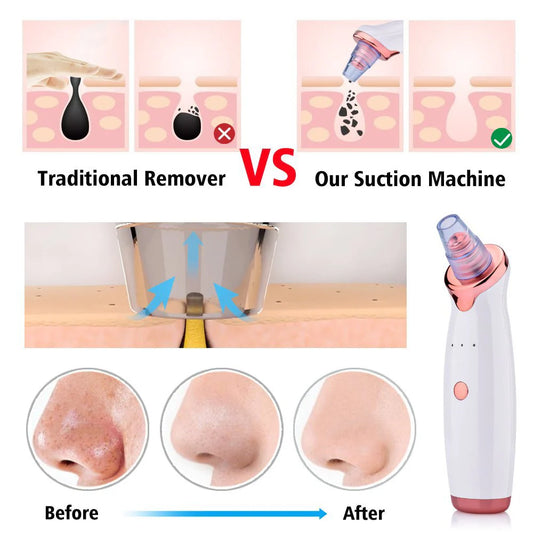Rechargeable Blackhead Remover